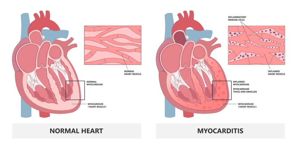 myocarditis-what-are-the-symptoms-causes-and-treatment