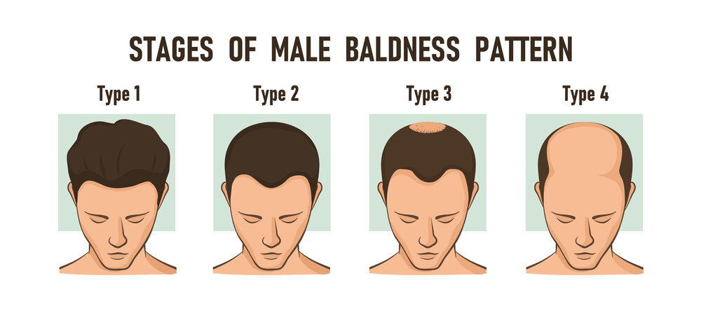 Propecia For Hair Loss (Male Pattern Baldness) - Expert's Advice