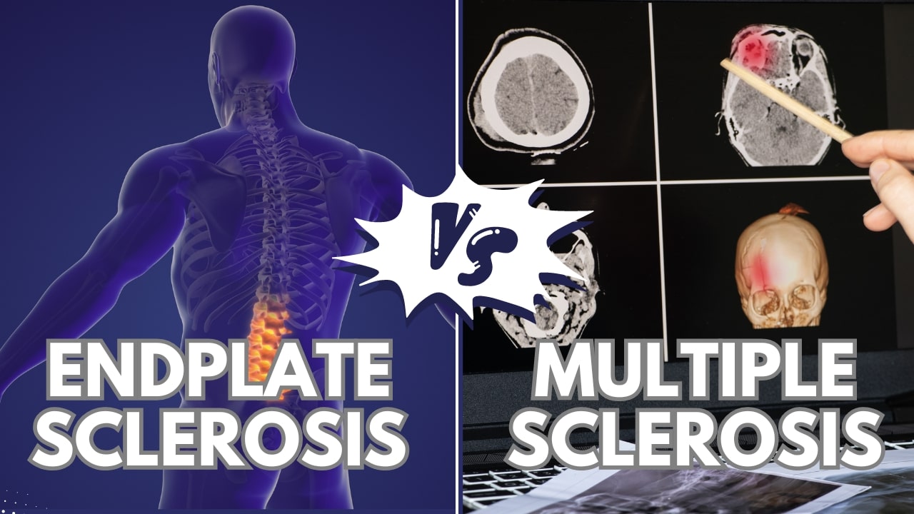 Is Endplate Sclerosis The Same As Multiple Sclerosis?